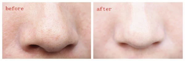 一次就可以把黑头去掉的方法,去黑头和粉头不伤害皮肤的方法