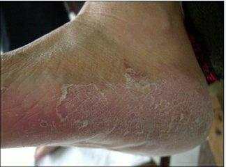 治疗脚气的最便捷方法,除脚气的绝招