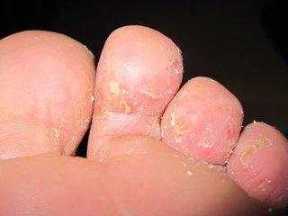 治疗脚气的最便捷方法,除脚气的绝招