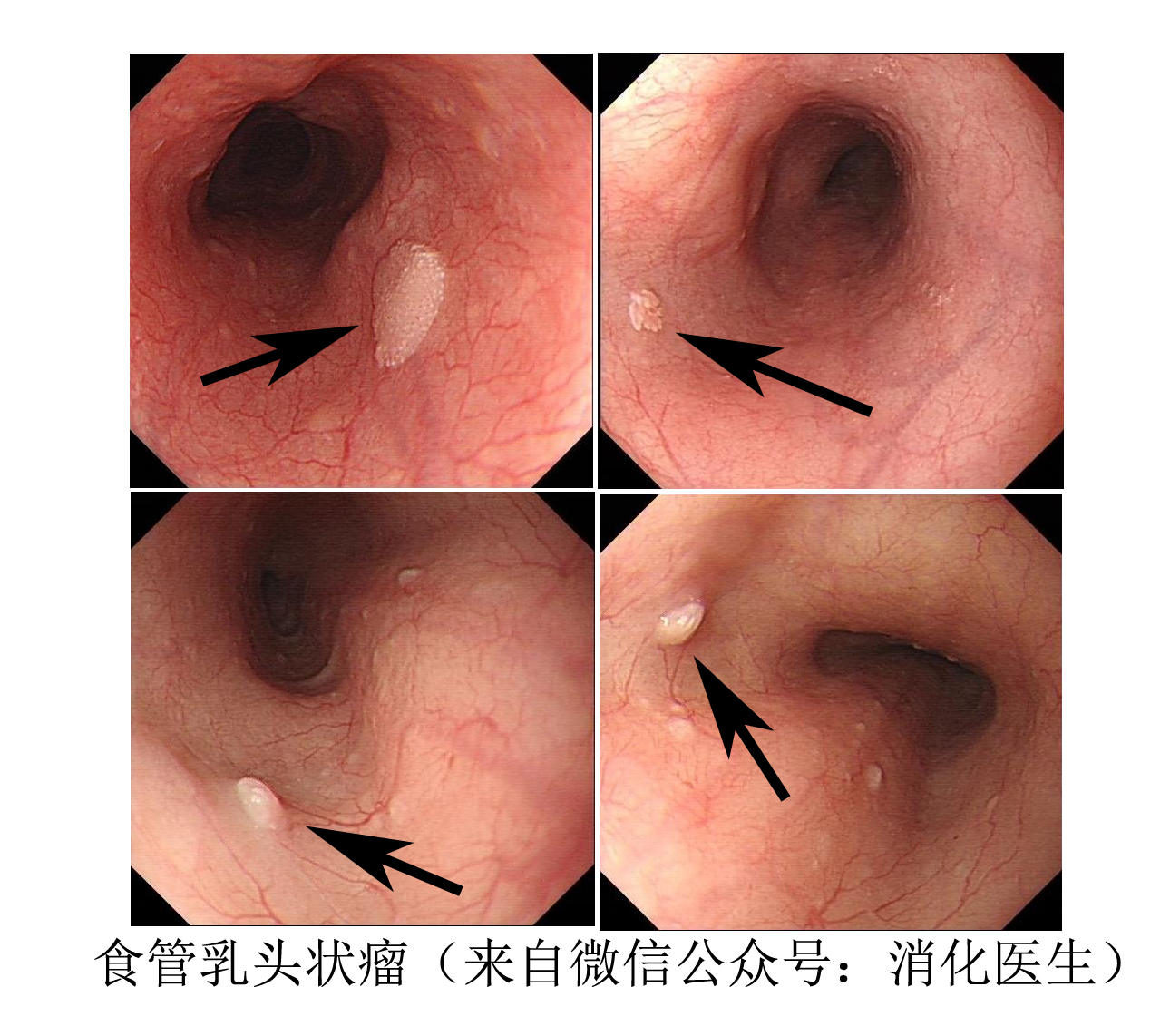 食管良性肿瘤的症状有哪些,食管恶性肿瘤中晚期怎么治