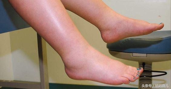 孕妇水肿吃什么东西消肿最快,宫内胎儿水肿孕妇吃什么可消肿