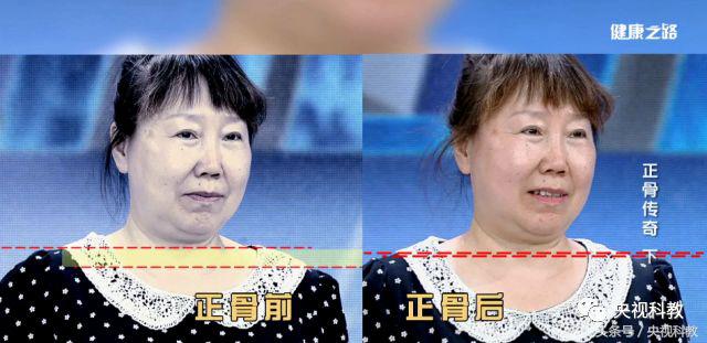 中医正骨治疗腰疼视频,腰疼最快缓解方法躺床上正骨