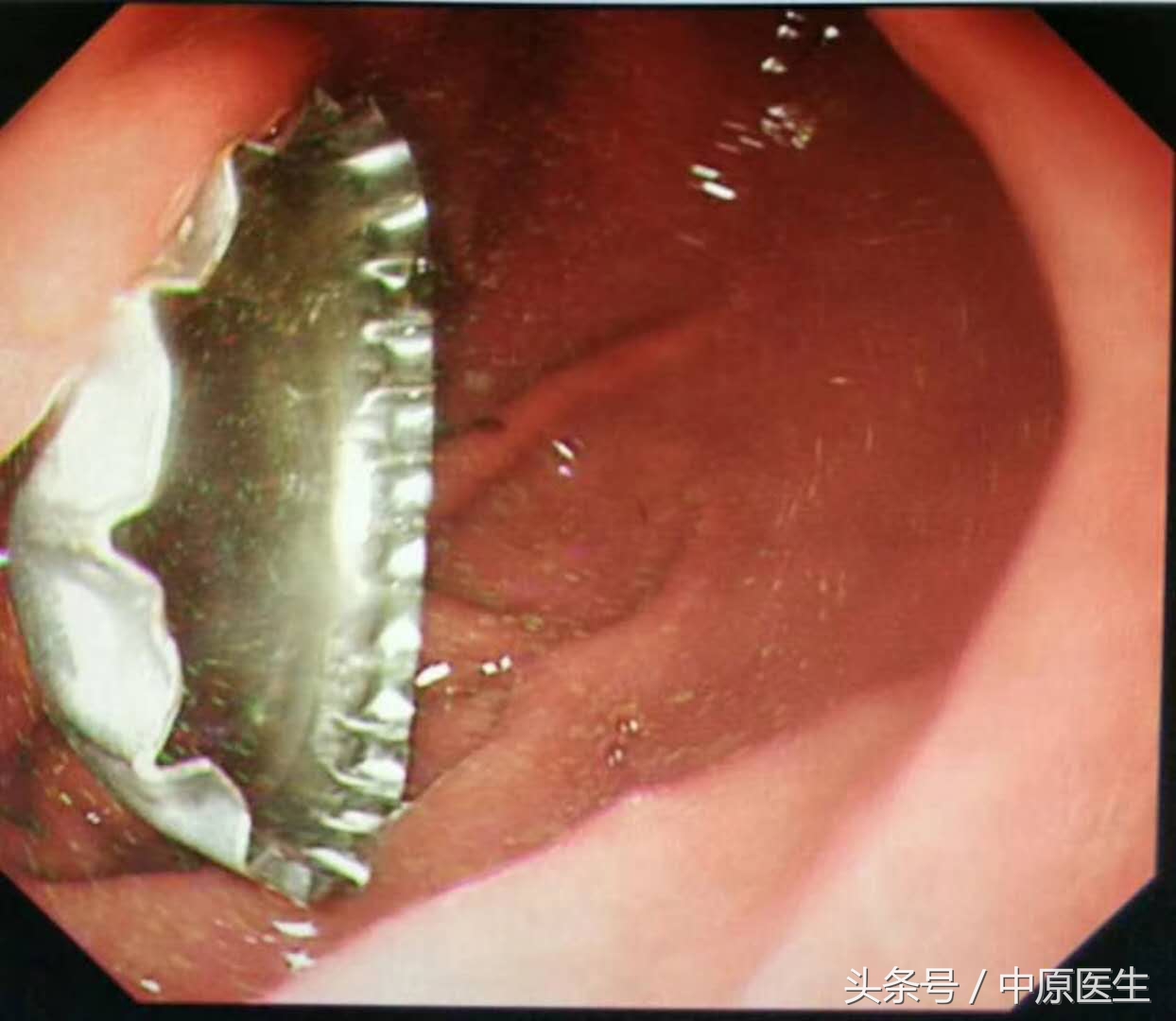 让人脑洞大开的“套套”用法:专家把男子喝到胃里的啤酒盖取出
