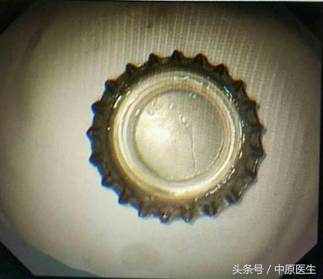 让人脑洞大开的“套套”用法:专家把男子喝到胃里的啤酒盖取出