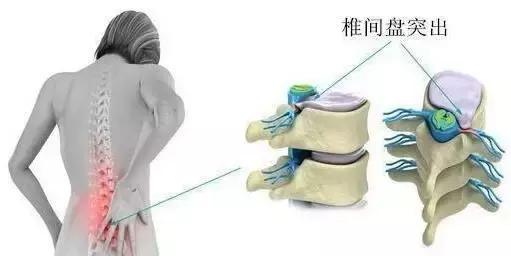 正骨复位手法视频腰椎间盘突出,不扎针不推拿腰椎整脊复位