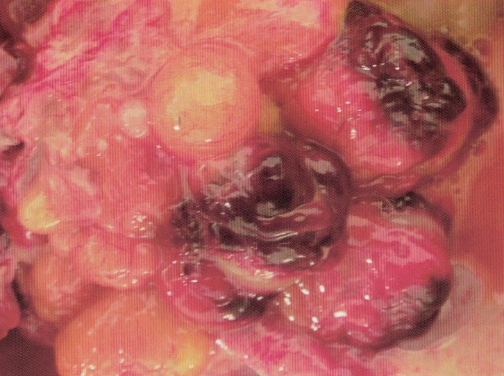 鹌鹑禽流感解剖图,鸡患禽流感症状及图片