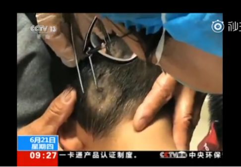 十几个月大的孩子因为它几乎毁容，夏天这两种虫要警惕……