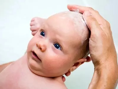 宝宝头皮上有油泥怎么处理,两个月宝宝头皮结黄痂怎么处理