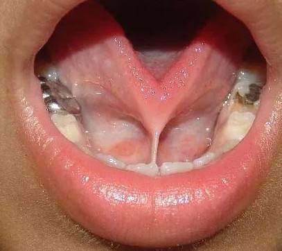 舌系带割掉,舌系带切除的优缺点