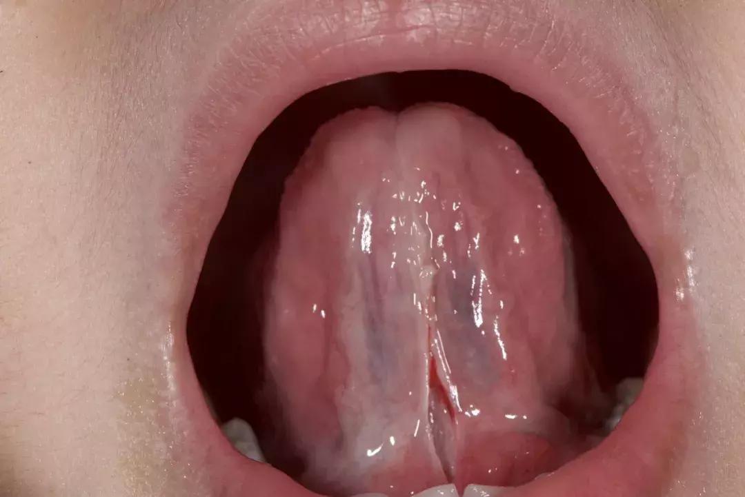 孩子口腔系带有什么危害,儿童上唇系带连接牙龈有什么影响