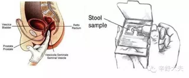 22岁女孩,体检肛门指诊检查,发现“肿物”,原来竟然是这个!