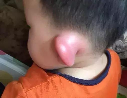 五个月宝宝止痒小妙招,夏天老人身上痒快速止痒妙招