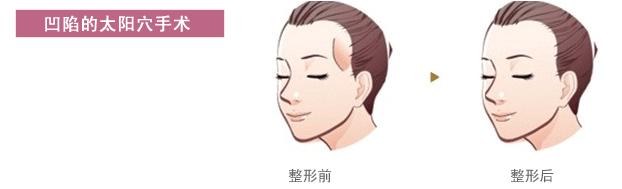 太阳穴填充需要注意什么才能更美,太阳穴填充怎么才能填得高级