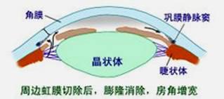 眼压太高用的散瞳药有危害吗,降低眼压的药水和散瞳药水一样吗