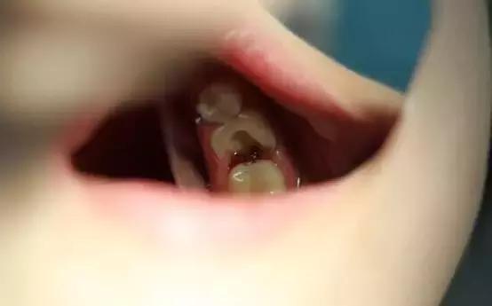 7岁女孩牙齿龋坏怎么办,7岁女童牙齿坏到牙龈怎么办