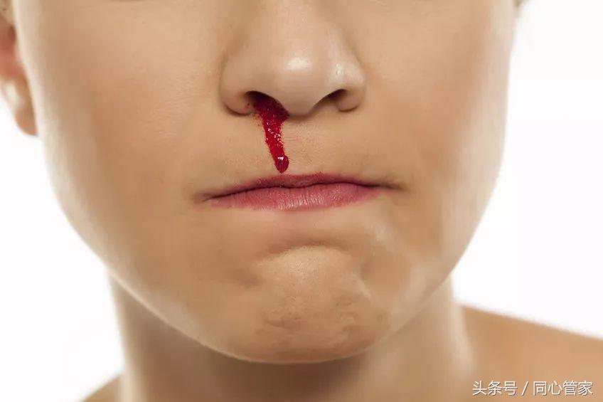 做血管支架手术后流鼻血怎么回事,淤青内出血要保持什么姿势