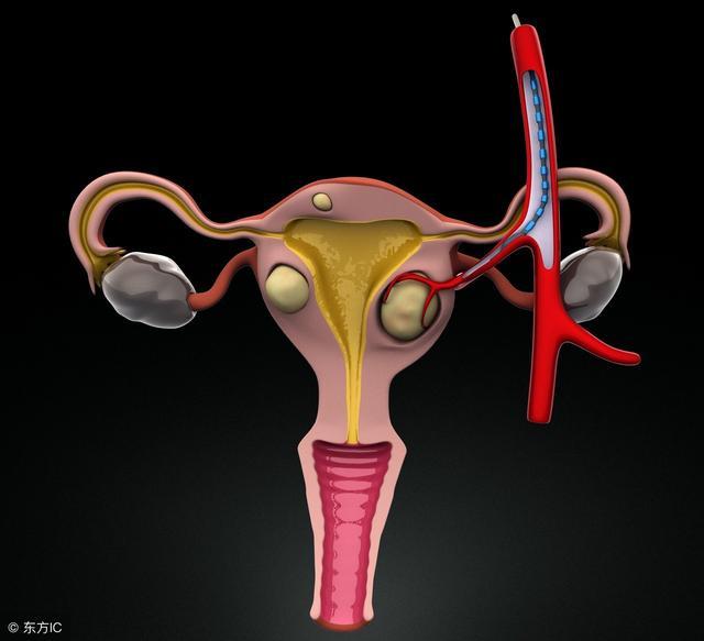 子宫肌瘤可以刮宫处理吗,粘膜下子宫肌瘤最适合的处理方法