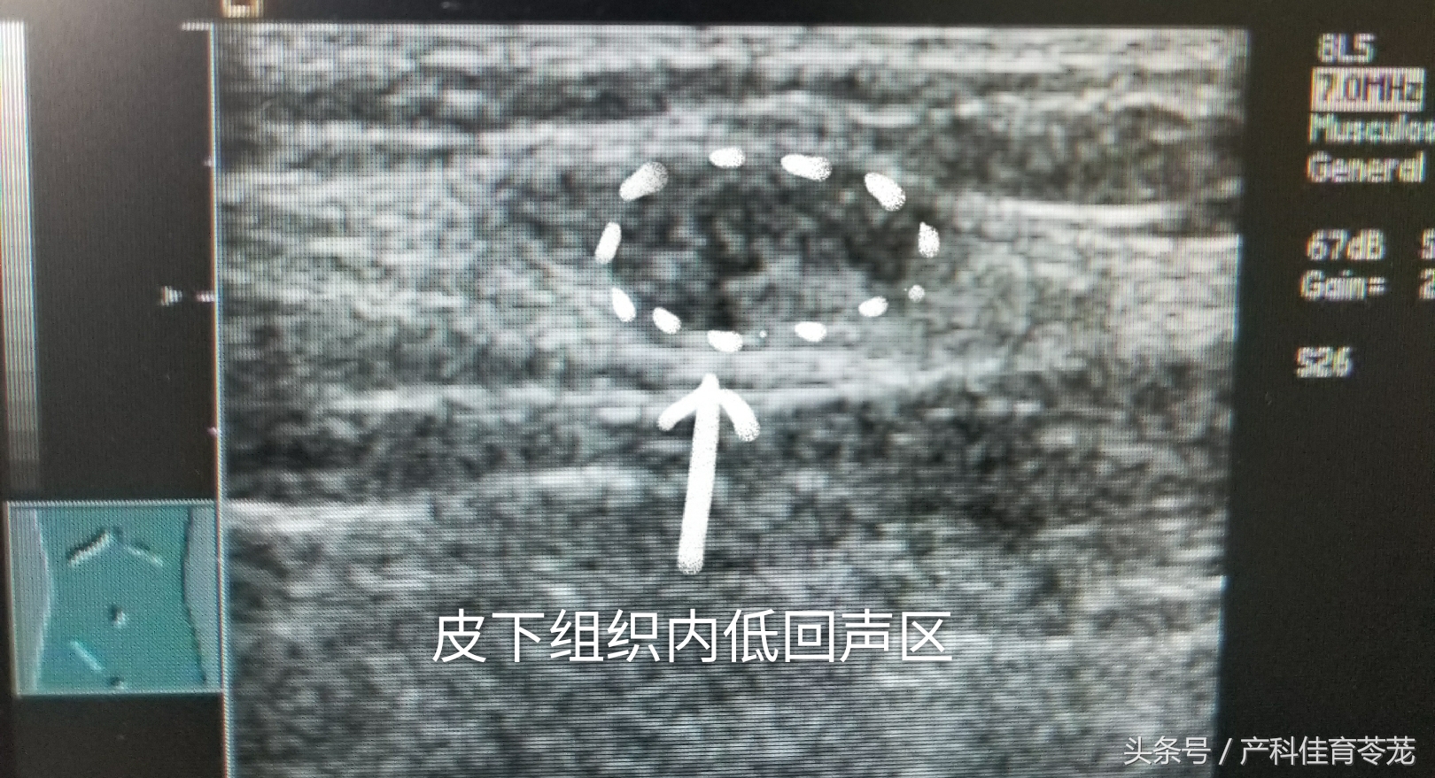 剖宫产后子宫内膜异位症,剖腹产后子宫内膜异位症注意事项