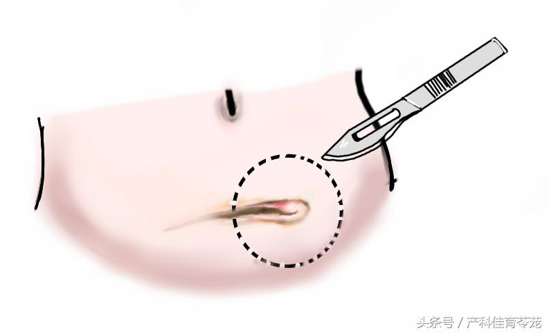 剖宫产后子宫内膜异位症,剖腹产后子宫内膜异位症注意事项