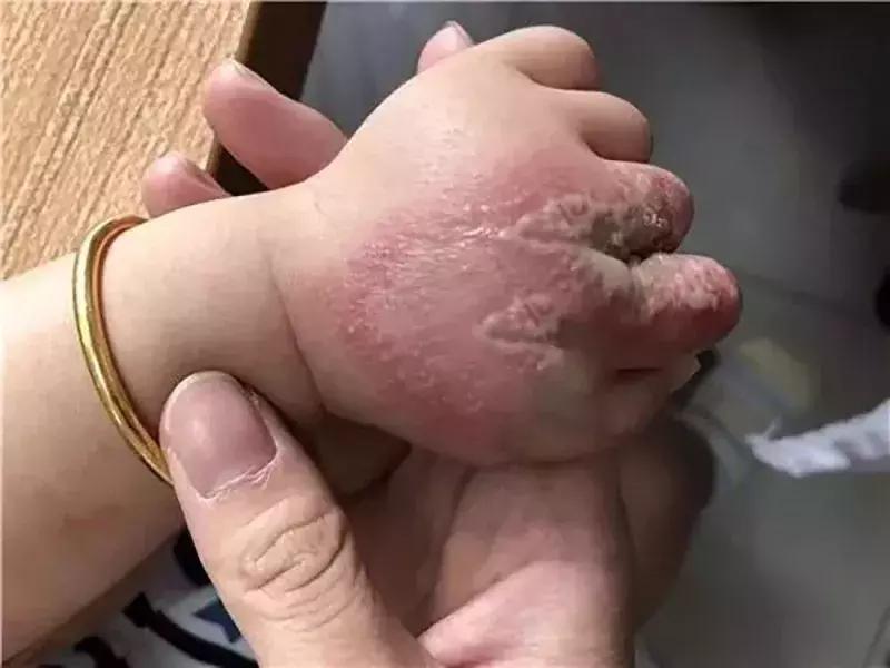 夏季宝宝如何预防虫咬皮炎,夏天宝宝招虫子怎么处理
