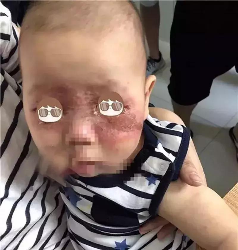 夏季宝宝如何预防虫咬皮炎,夏天宝宝招虫子怎么处理