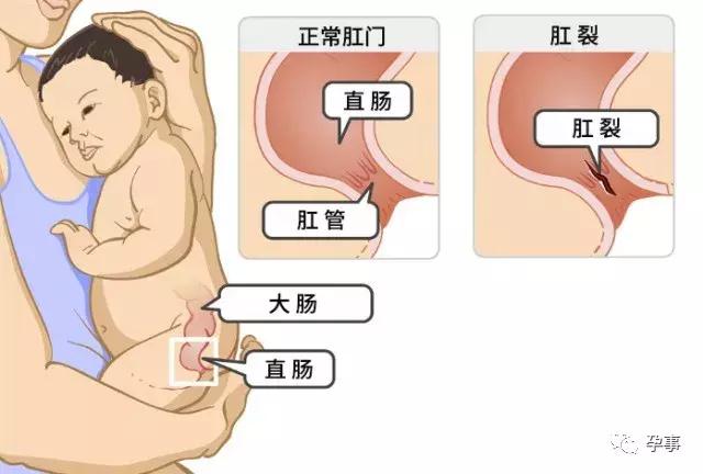 3个月宝宝大便带血丝是什么原因,3个月宝宝大便带血怎么办