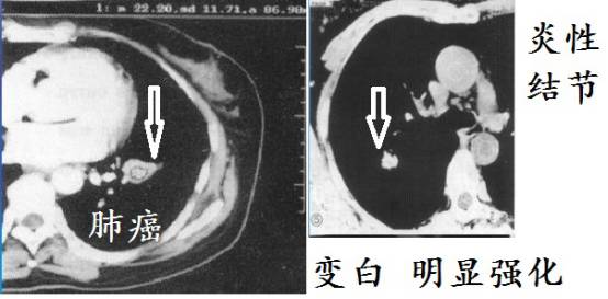 ct诊断肺癌肺结核,ct诊断出肺结核准确率高吗