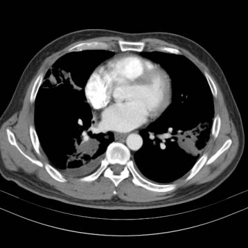 ct诊断肺癌肺结核,ct诊断出肺结核准确率高吗