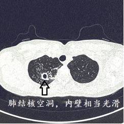 ct诊断肺癌肺结核,ct诊断出肺结核准确率高吗