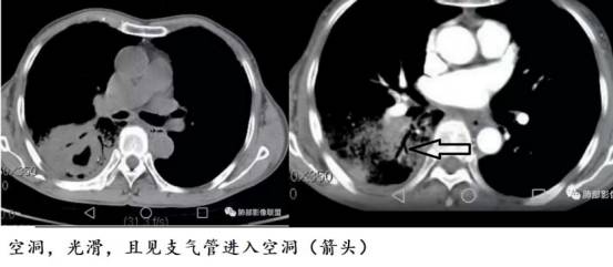 ct诊断肺癌肺结核,ct诊断出肺结核准确率高吗