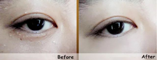 不用针挑、手挤,一涂一撕,脂肪粒自动脱落,两周见效