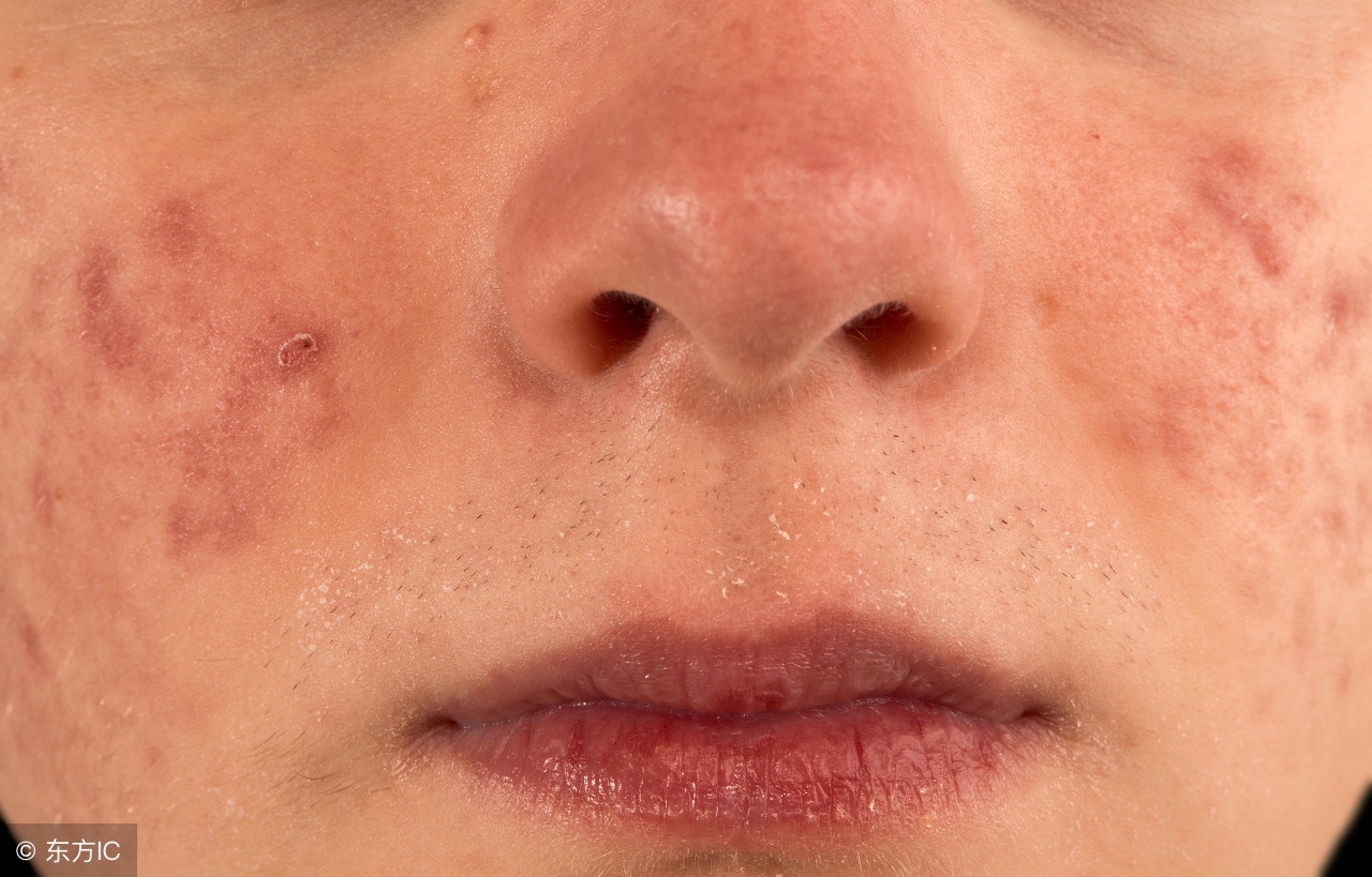 脸上长了好多粉刺有什么好办法吗,脸上长粉刺怎么办有效的方法