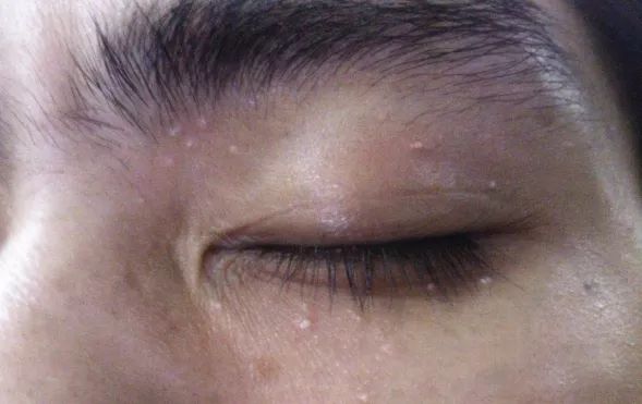 不用针挑、手挤,一涂一撕,脂肪粒自动脱落,两周见效