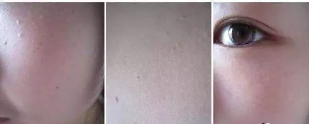 不用针挑、手挤，一涂一撕，脂肪粒自动脱落，两周见效