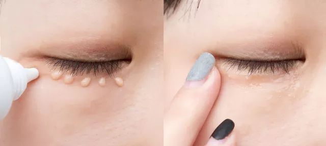 不用针挑、手挤,一涂一撕,脂肪粒自动脱落,两周见效