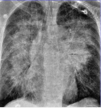 蝶翼征是间质性肺水肿的表现吗,肺蝶翼征