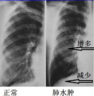 蝶翼征是间质性肺水肿的表现吗,肺蝶翼征