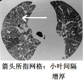 蝶翼征是间质性肺水肿的表现吗,肺蝶翼征
