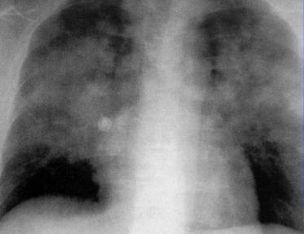 蝶翼征是间质性肺水肿的表现吗,肺蝶翼征