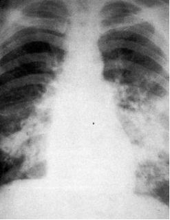 蝶翼征是间质性肺水肿的表现吗,肺蝶翼征