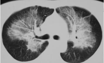 蝶翼征是间质性肺水肿的表现吗,肺蝶翼征