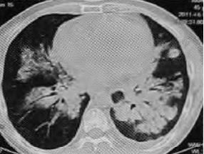 蝶翼征是间质性肺水肿的表现吗,肺蝶翼征