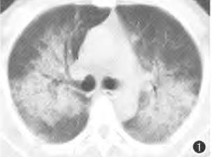 蝶翼征是间质性肺水肿的表现吗,肺蝶翼征