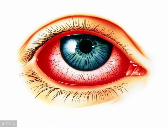 孩子得了结膜炎的图片,得了结膜炎眼睛很模糊