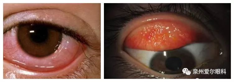 世界过敏性疾病日——全面了解过敏性结膜炎