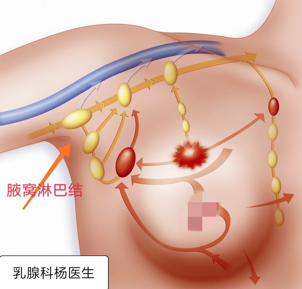 乳腺癌luminala型复发概率高不高,乳腺癌是什么情况下容易复发