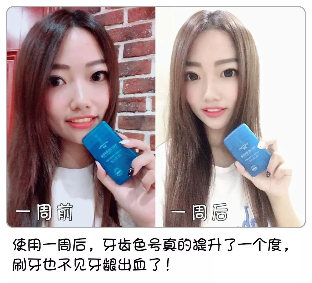 口腔强效除味剂,口腔抑制剂除异味