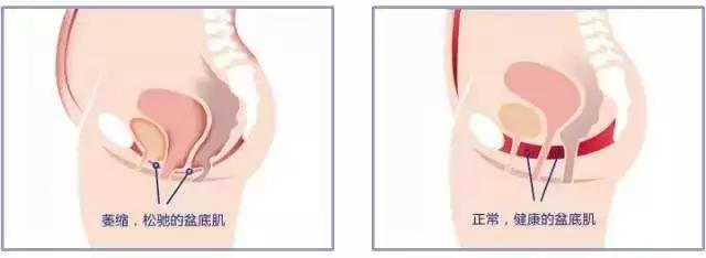 一胎盆底肌松弛二胎能锻炼好吗,一胎用的盆底肌仪器二胎还能用吗