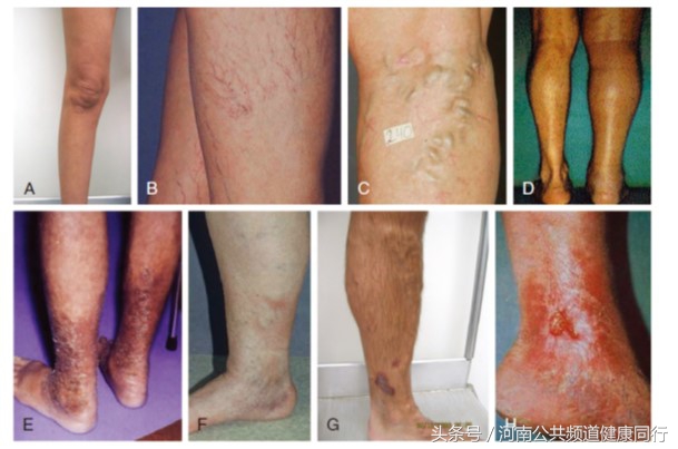 静脉曲张郑大一附院看哪个科,郑大一附院硬化剂治疗静脉曲张