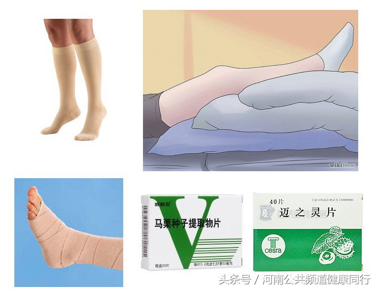 静脉曲张郑大一附院看哪个科,郑大一附院硬化剂治疗静脉曲张